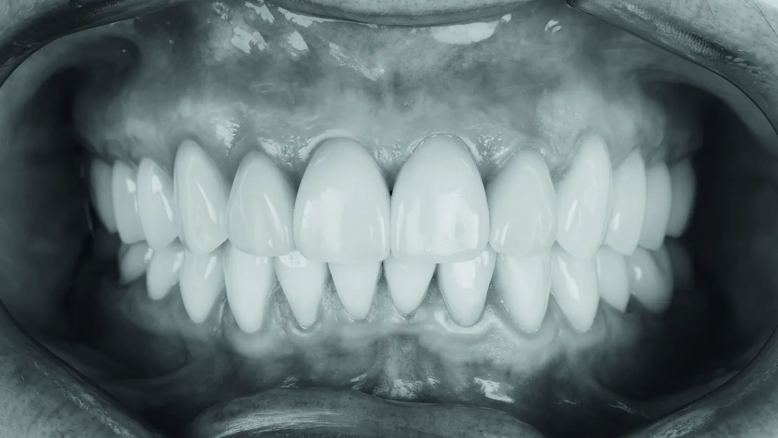 Sonrisa con carillas, vista frontal
